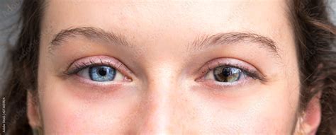 odd eyes human|Heterochromia iridum .